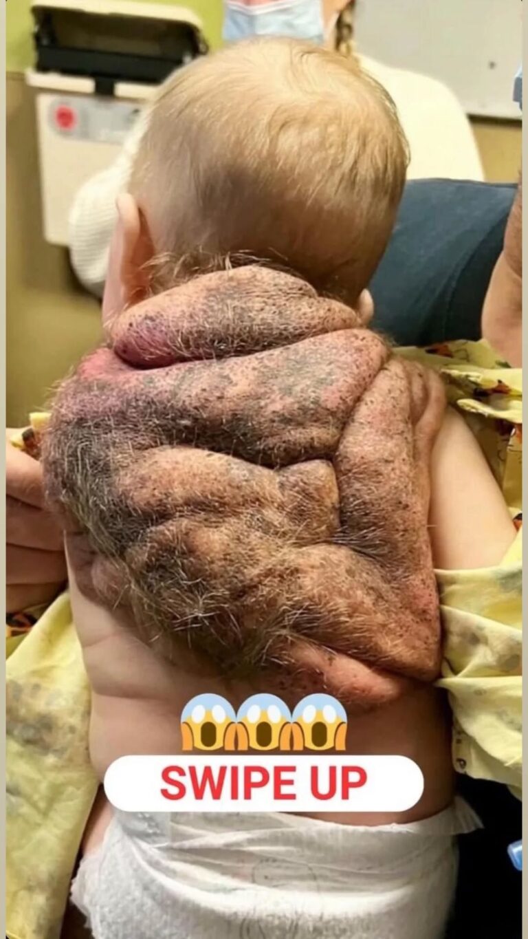 Her Little Superhero Was Born With His Own ‘Ninja Turtle Baby’ Shell