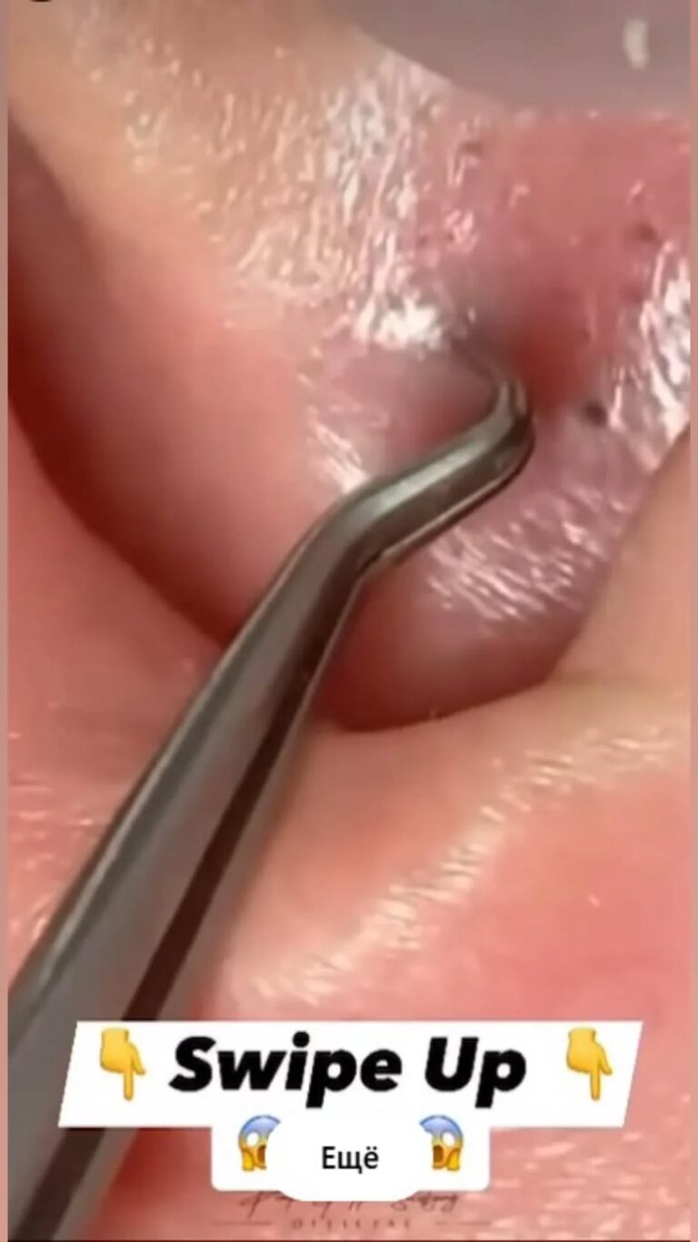 Best 15 Tips For Squeezing Blackheads On Nose